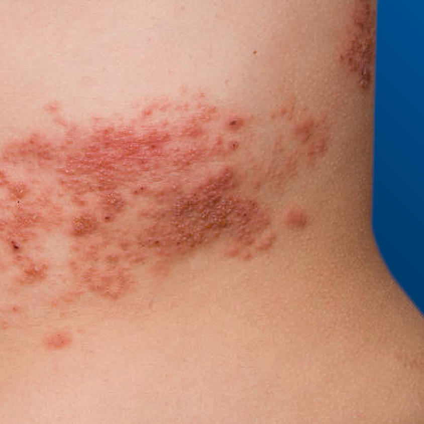 Иконка_опоясывающий_герпес_