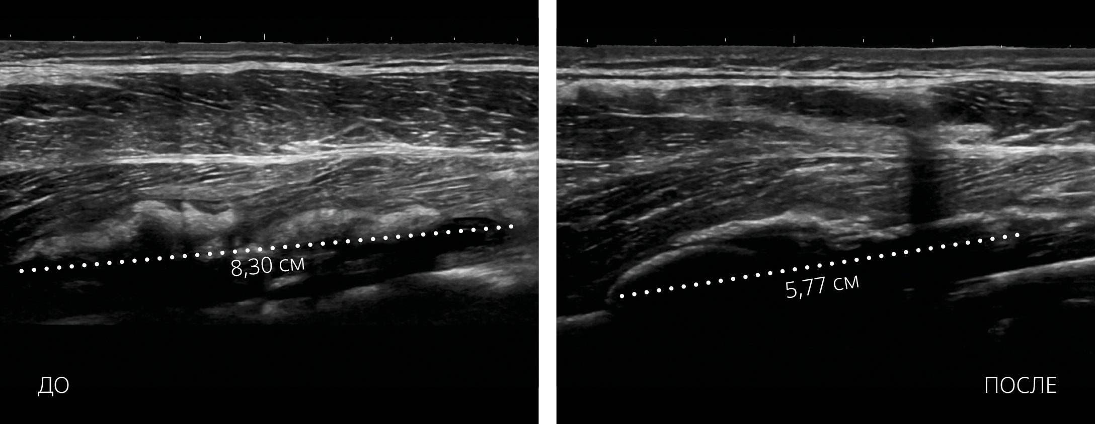 HILT Травмы мышц