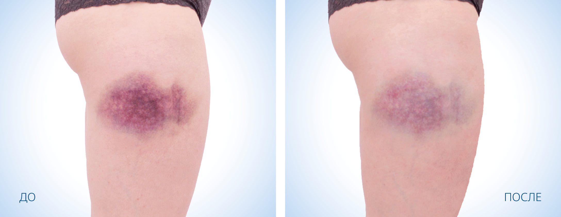 HILT Спортивные травмы