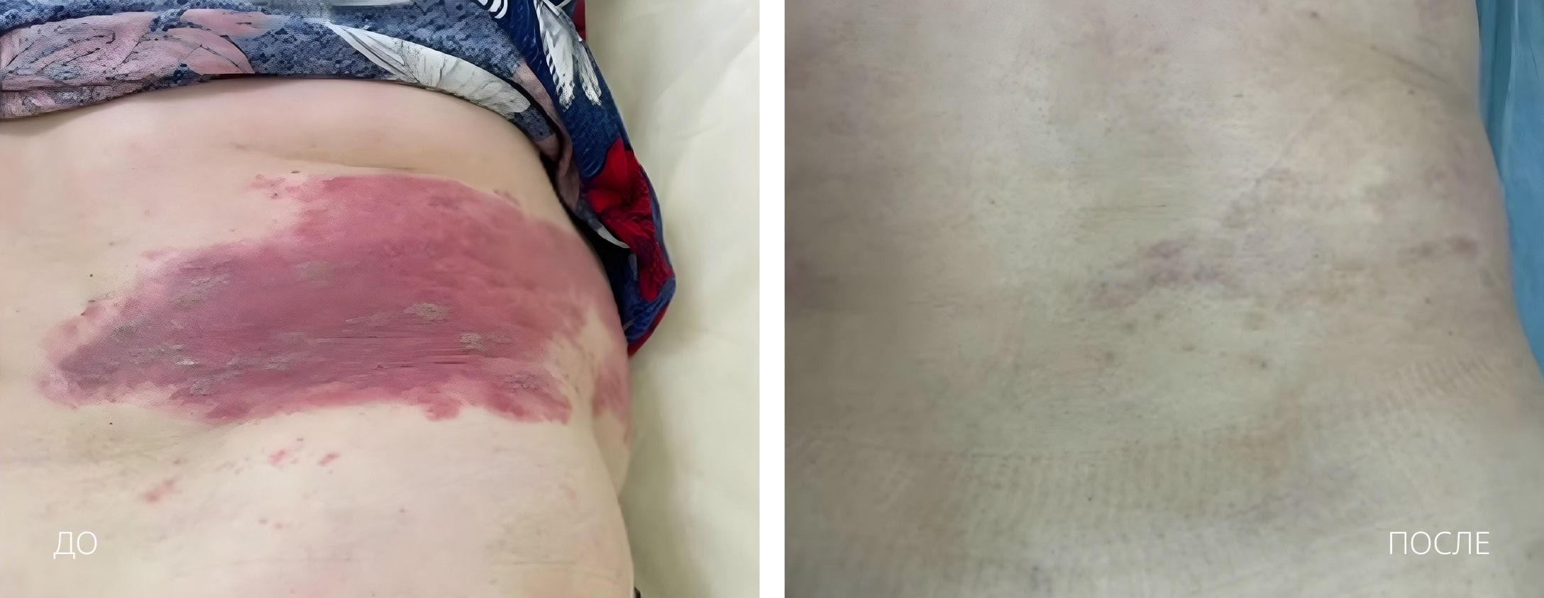 HILT Опоясывающий герпес