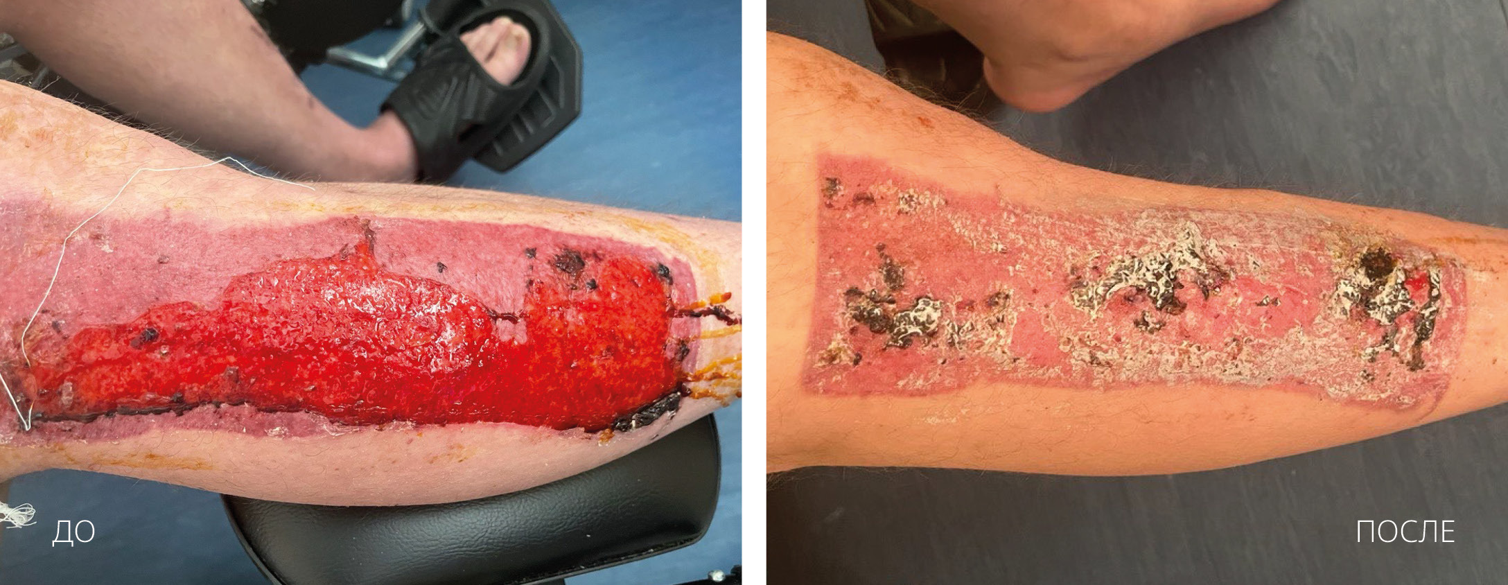 HILT Открытые раны