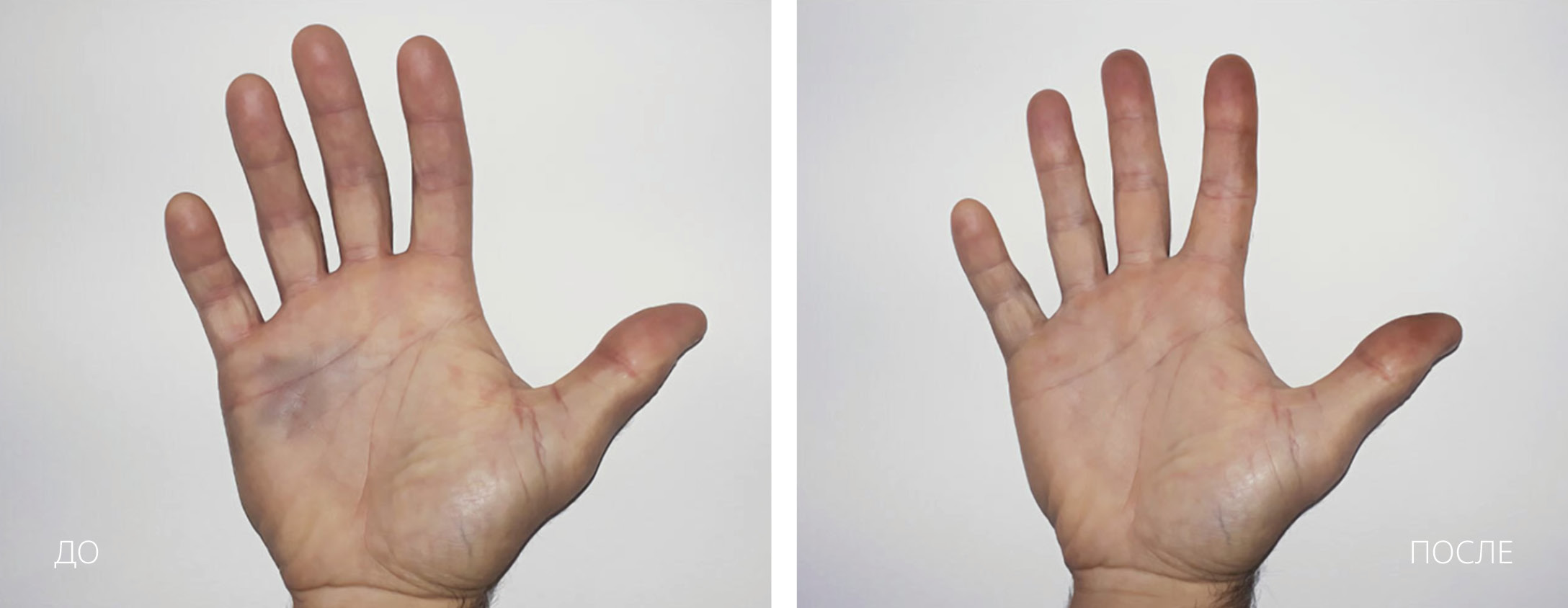 HILT Растяжение связок