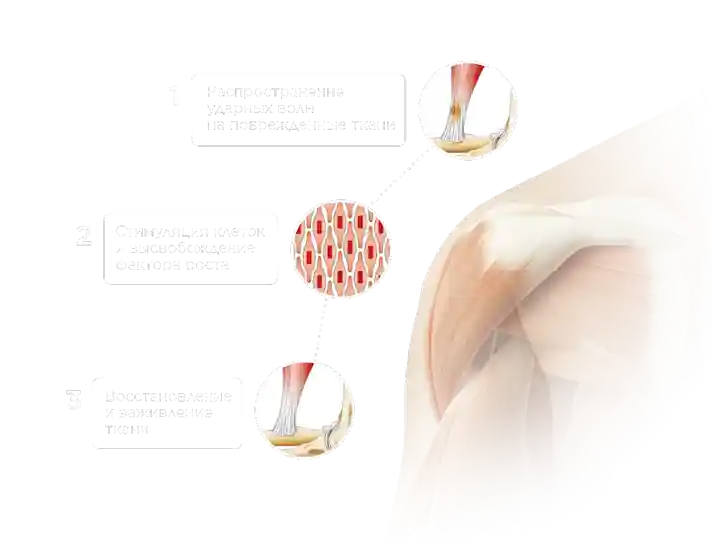 Показания для УВT