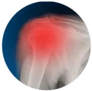 Синдром замороженного плеча