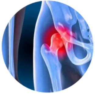 Коксартроз, гонартроз