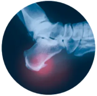 Пяточная шпора