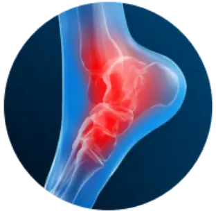 Растяжение связок